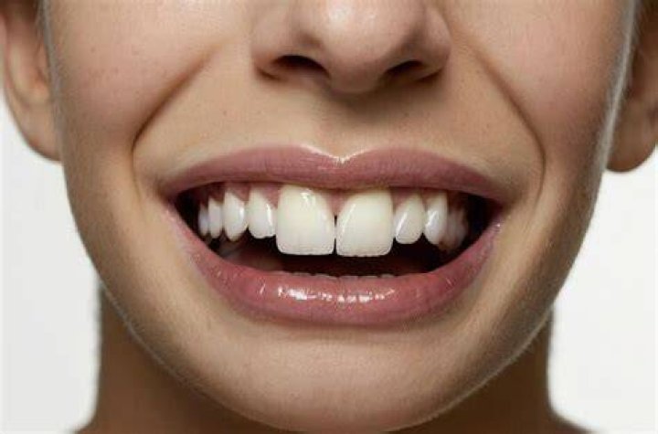Are big front teeth attractive?