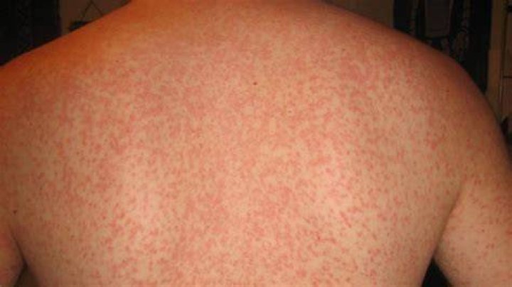 What does a strep rash look like in adults?